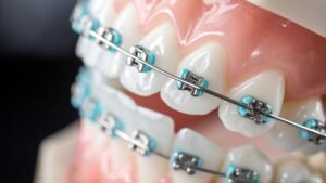 Close-up of braces with turquoise bands used for smile alignment and straightening teeth