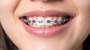 Orthodontic braces close-up for discussing is Damon braces better than traditional treatment