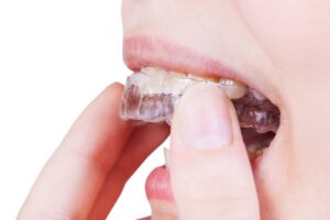 At-home clear aligners vs Invisalign